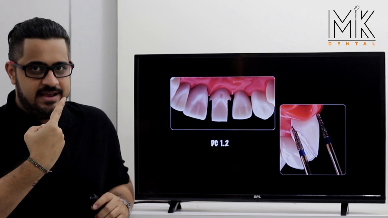 Tooth Preparation for Maxillary Central Incisor; Metal Free crown