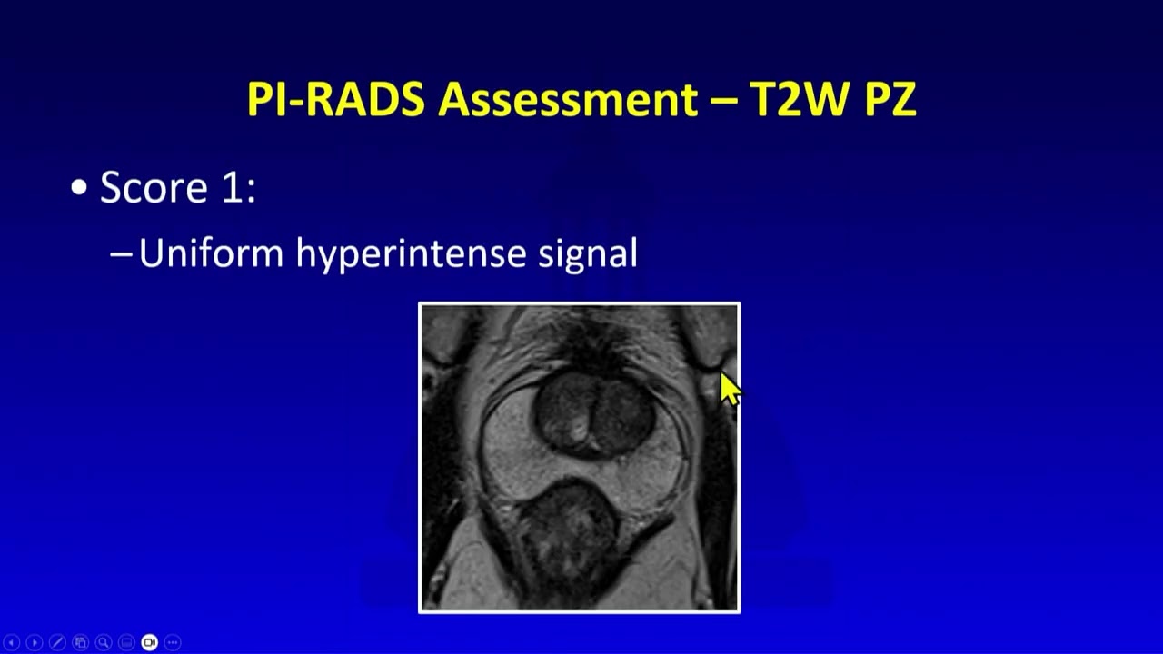 088 MRI of Prostate – PI RAD Primer – What You Really Need to Know Medstudylab.com