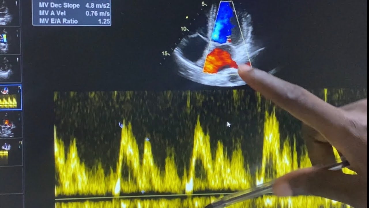 SPECTRAL DOPPLER ON ECHO