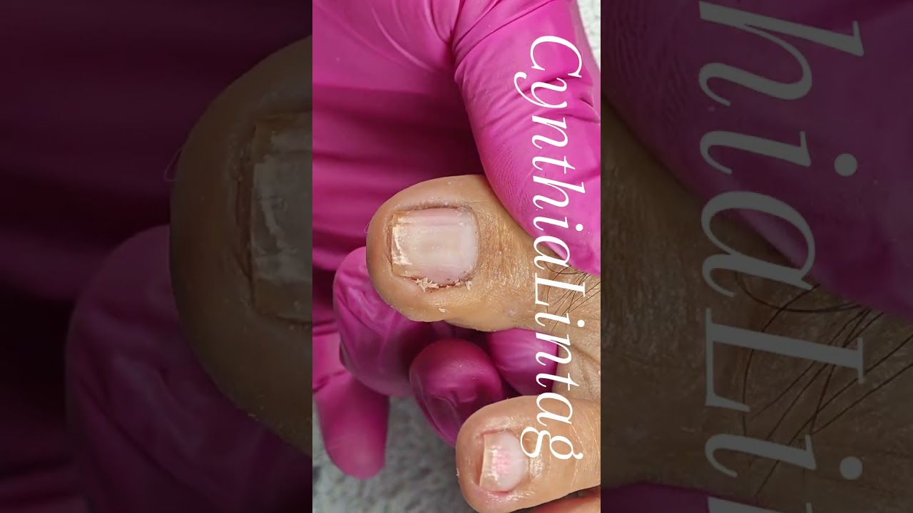 Full video pedicure with ingrown removal 