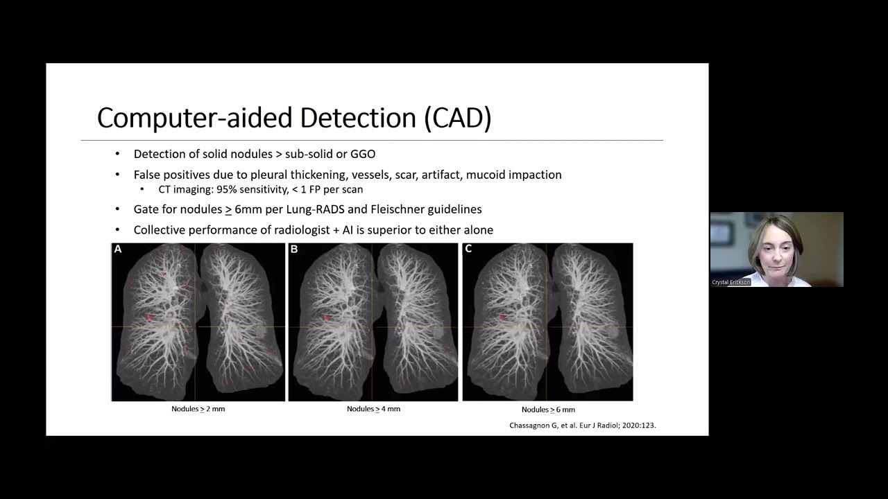 8 in 8 Series: Detecting Lung Cancer Earlier Through AI-Powered Software