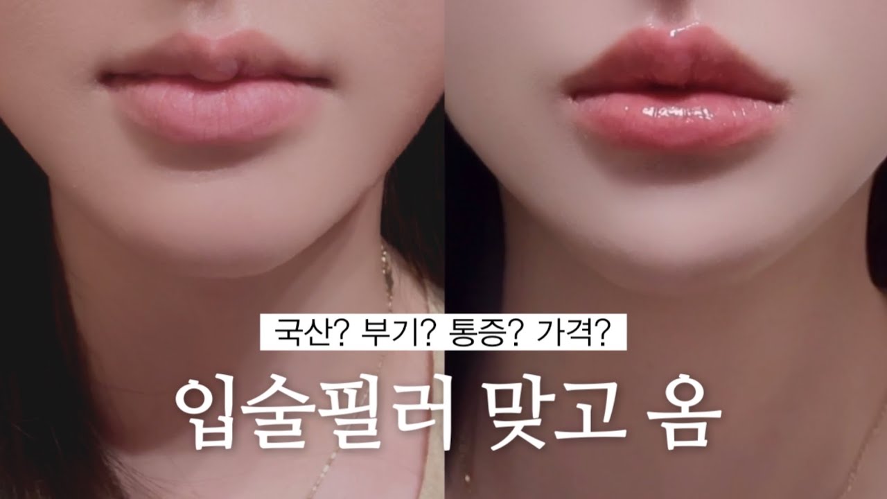 입술 예쁘다는 소리 100번 들은 입술필러 브이로그 후기 with 무물타임까지🫦❤️ | 유스필 필러