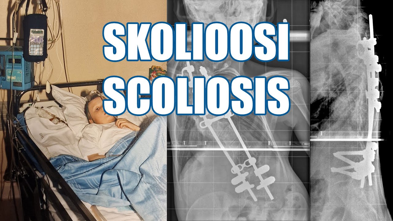 Sairasta elämää - Skolioosi - Scoliosis (english subtitles)