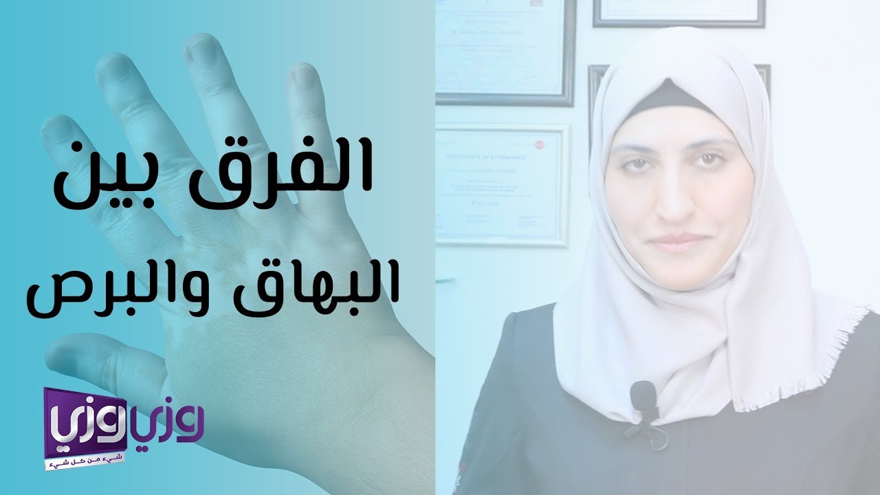 الفرق بين البهاق والبرص