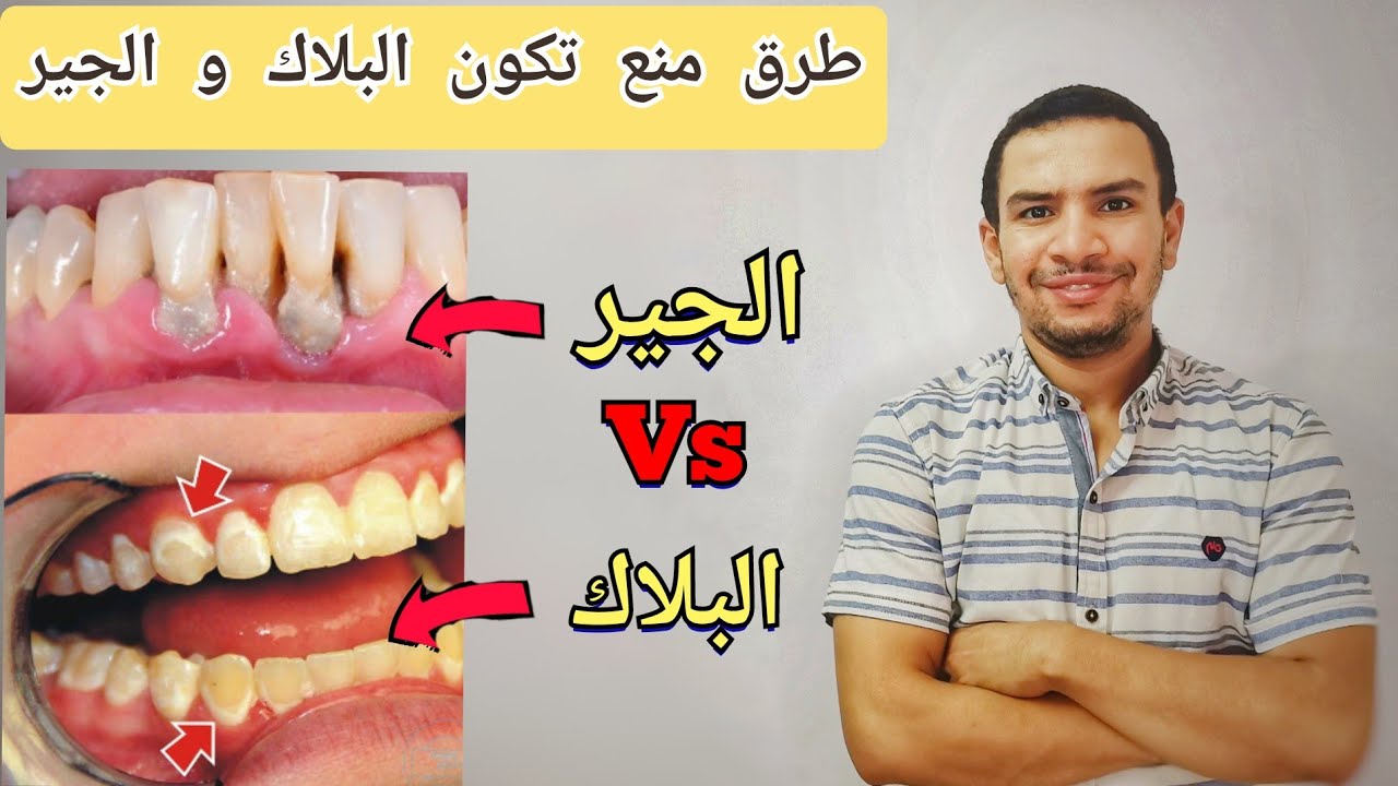ايهما اخطر البلاك ام جير الاسنان | ما لا يقوله لك طبيب الاسنان