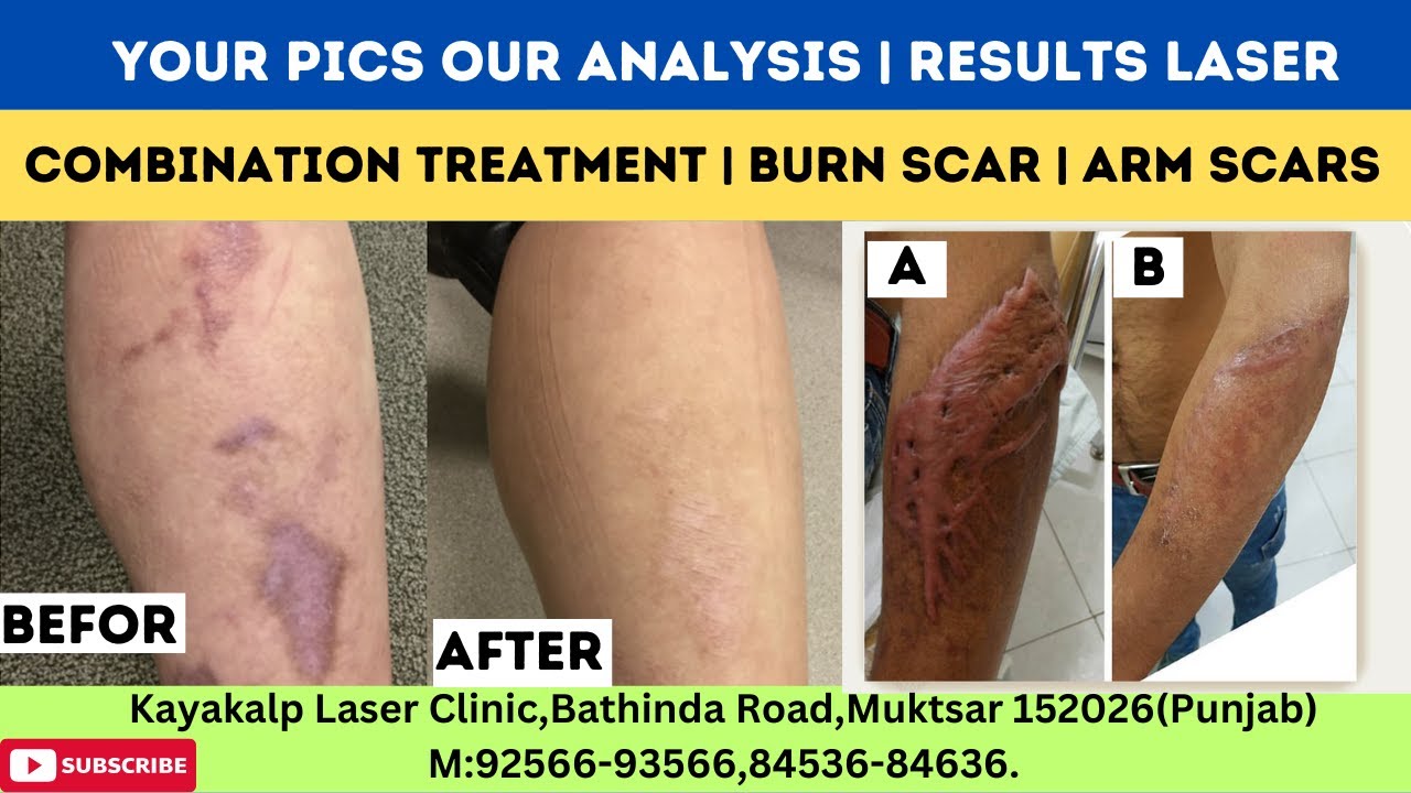 Your Pics our analysis | Results Laser Combination Treatment | Burn Scar | Arm Scars