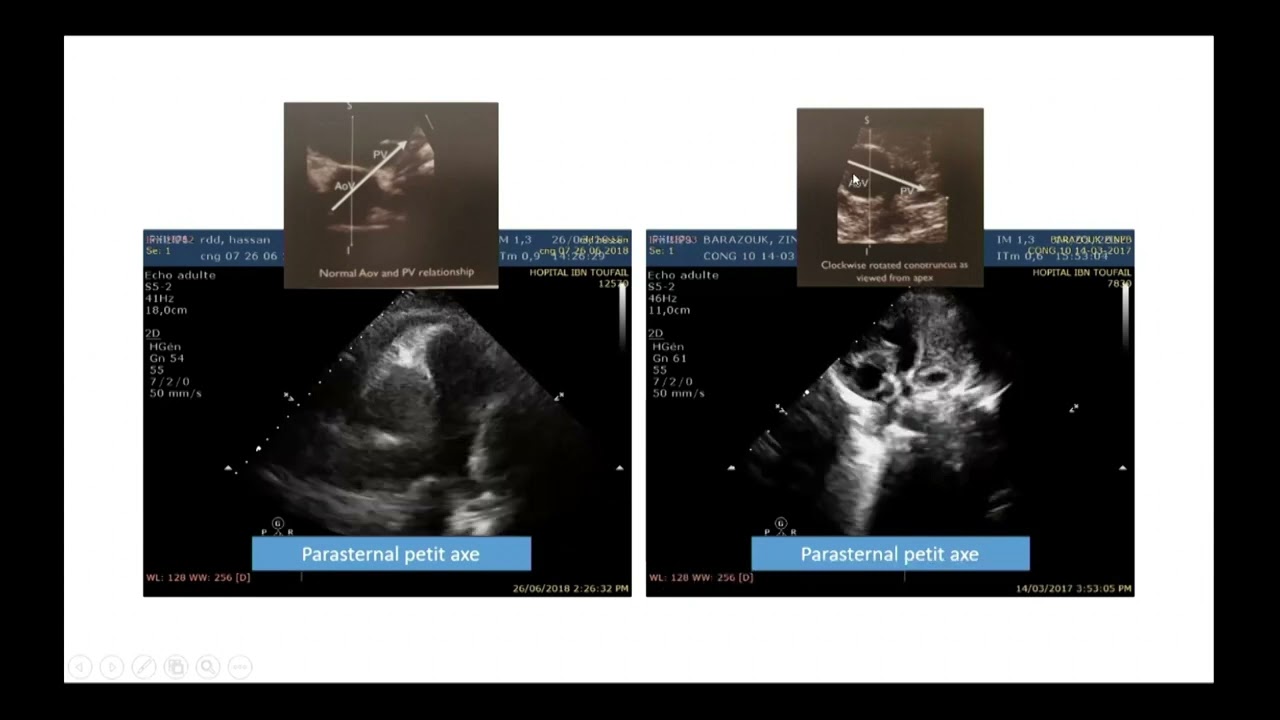2AM   L’Échocardiographie Doppler dans la tétralogie de Fallot   S  EL KARIMI