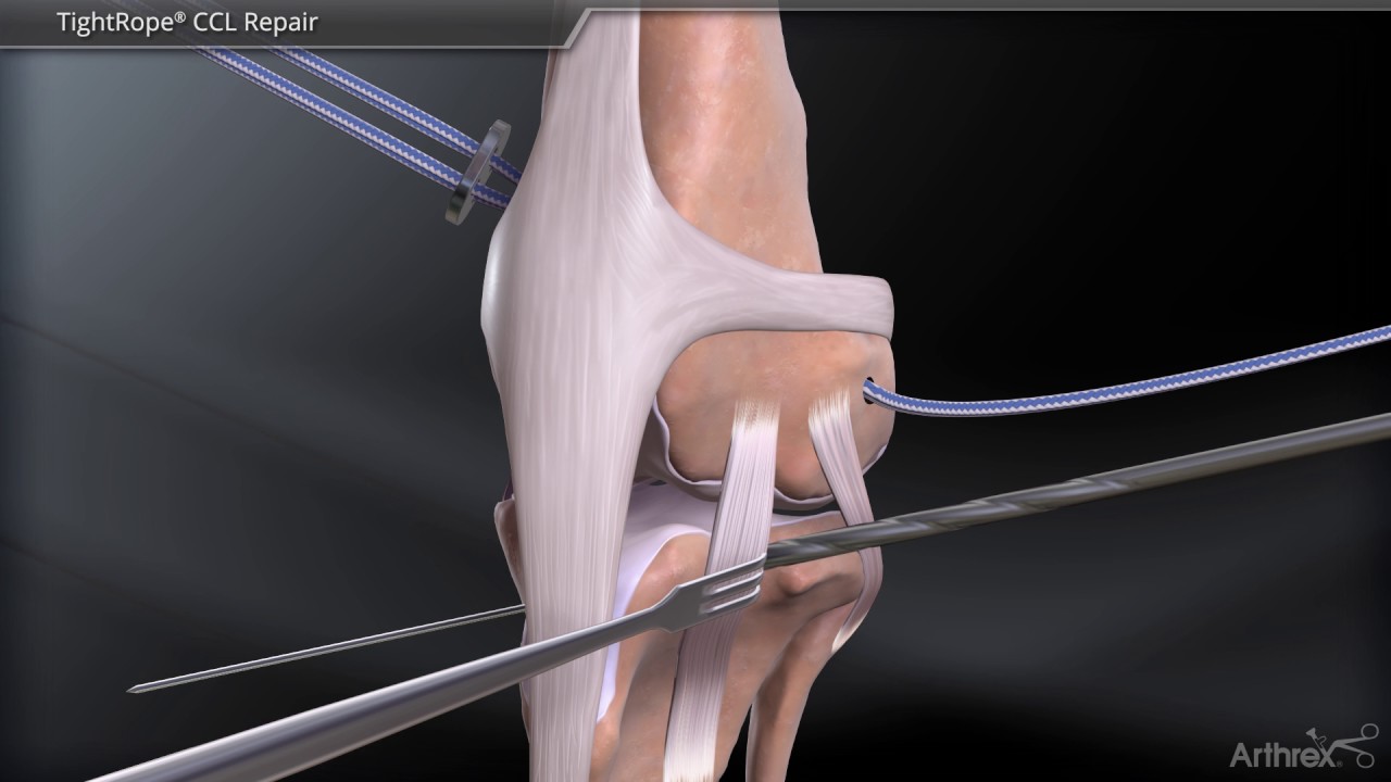 TightRope® CCL Repair