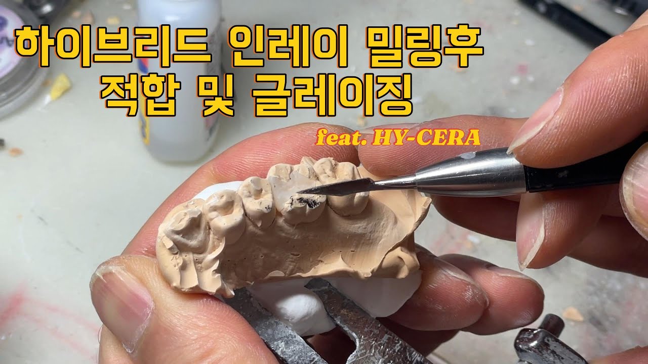 하이브리드 인레이 밀링후 적합및 글레이징과정