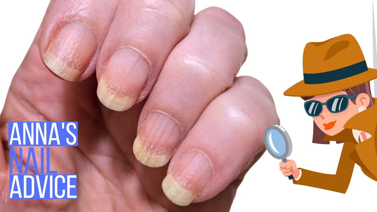 Yellow and dry nails when not wearing polish [Anna's Nail Advice]