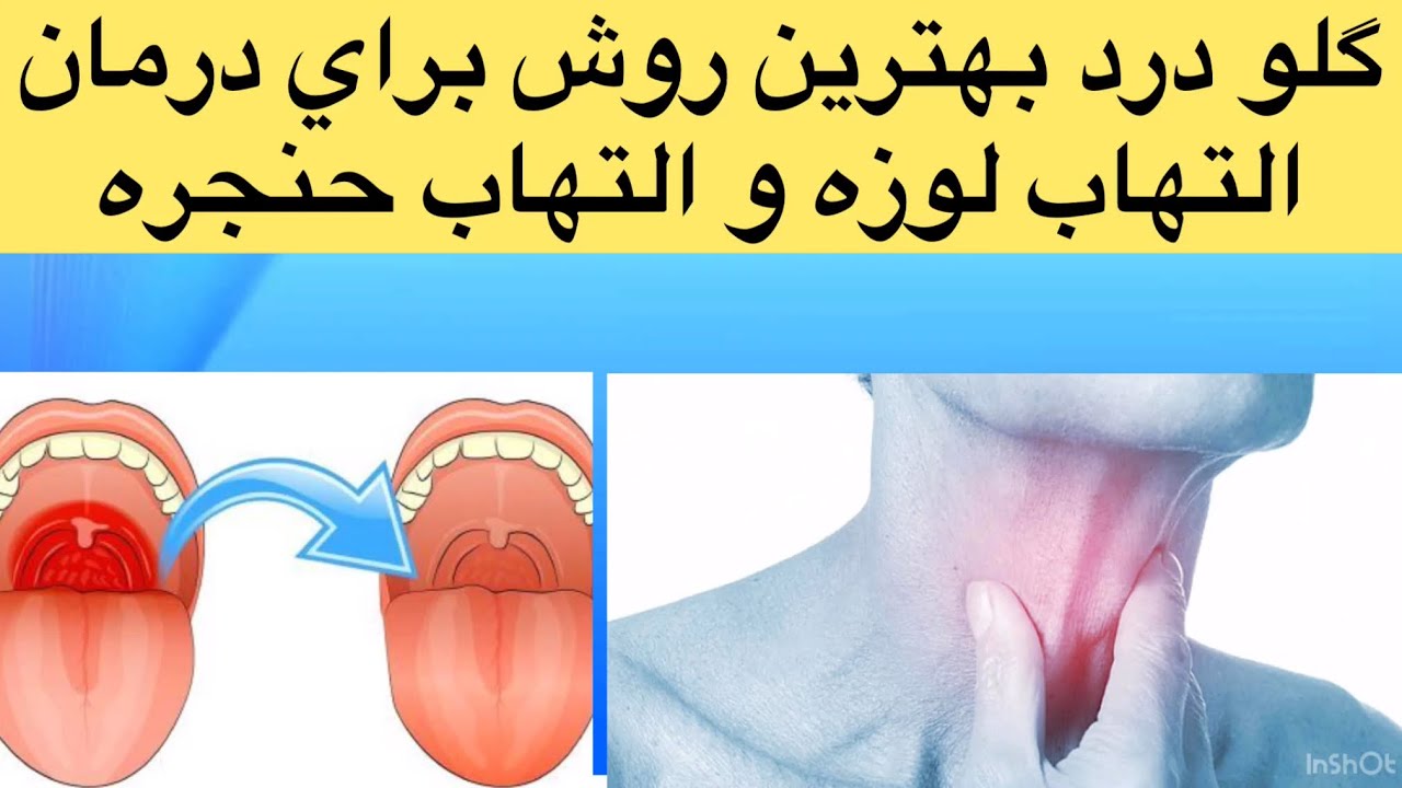 گلو درد چيست؟ بهترين روش براي درمان التهاب لوزه و التهاب حنجرهSore throat treatment