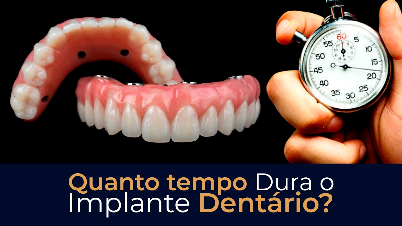 A Prótese Protocolo Dura Para Sempre? - Implace Implantes