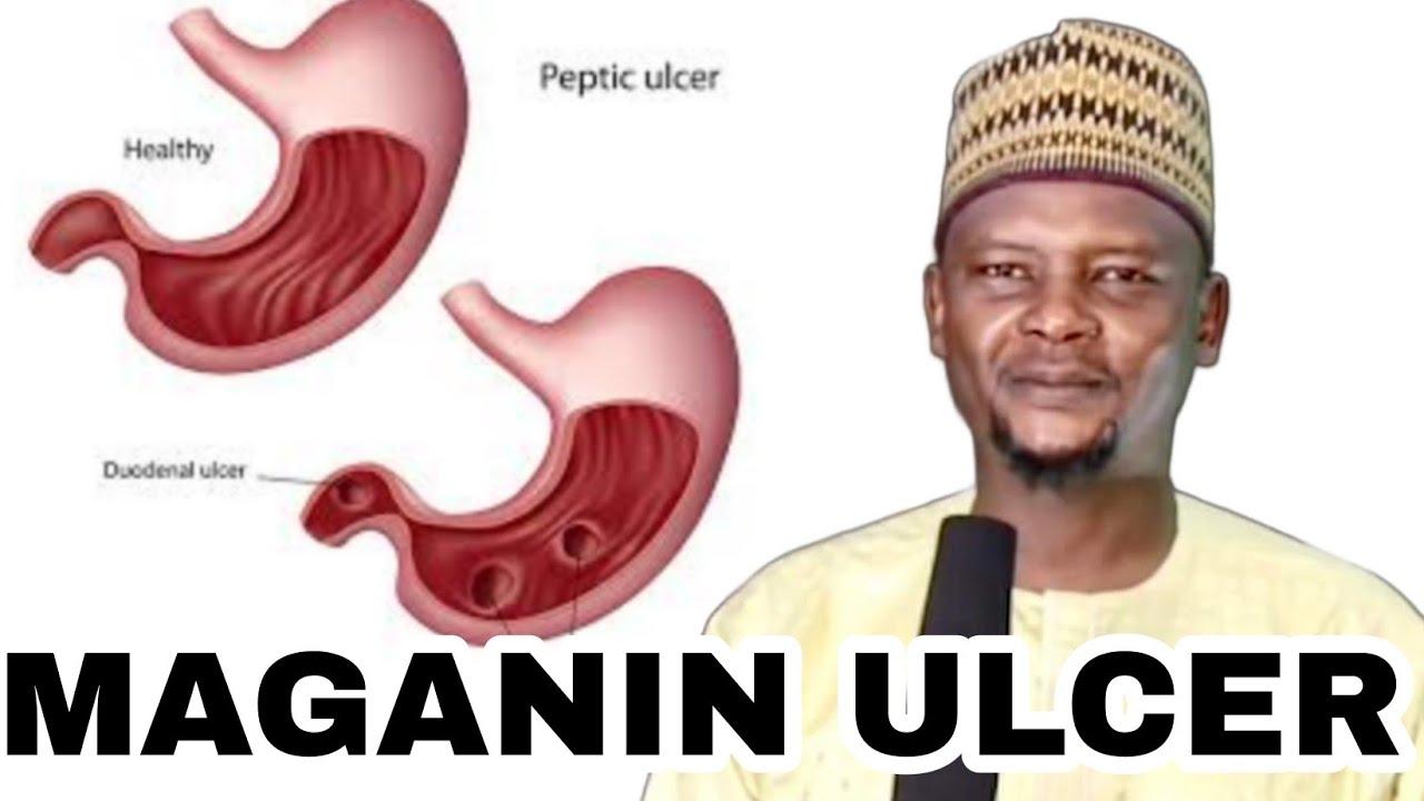 MAGANIN ULCER [] DR. ABDULWAHAB ABUBAKAR GONI BAUCHI HAFIZAHULLAH