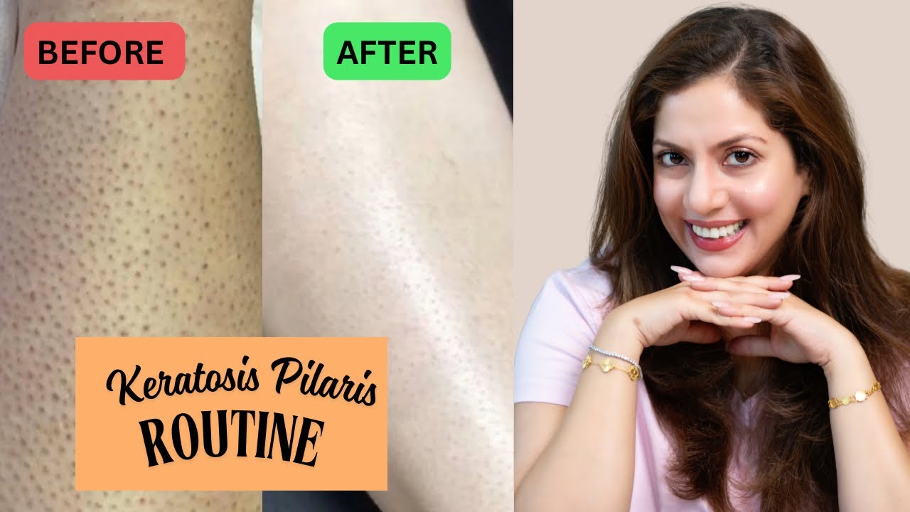 How to Treat Strawberry Skin at Home Treatment | Nipun Kapur