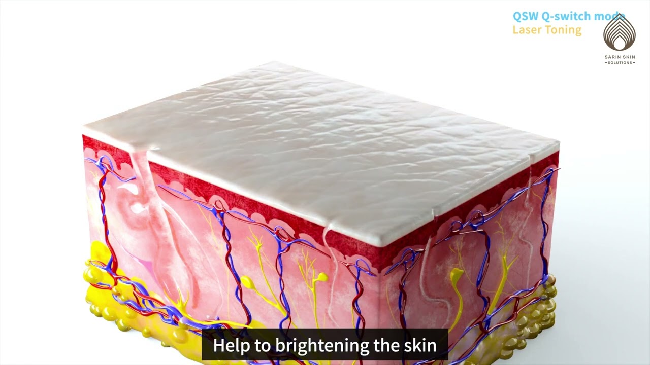 Q SWITCH LASER TONING : DR.ANKUR SAIN AND DR.JUSHYA SARIN