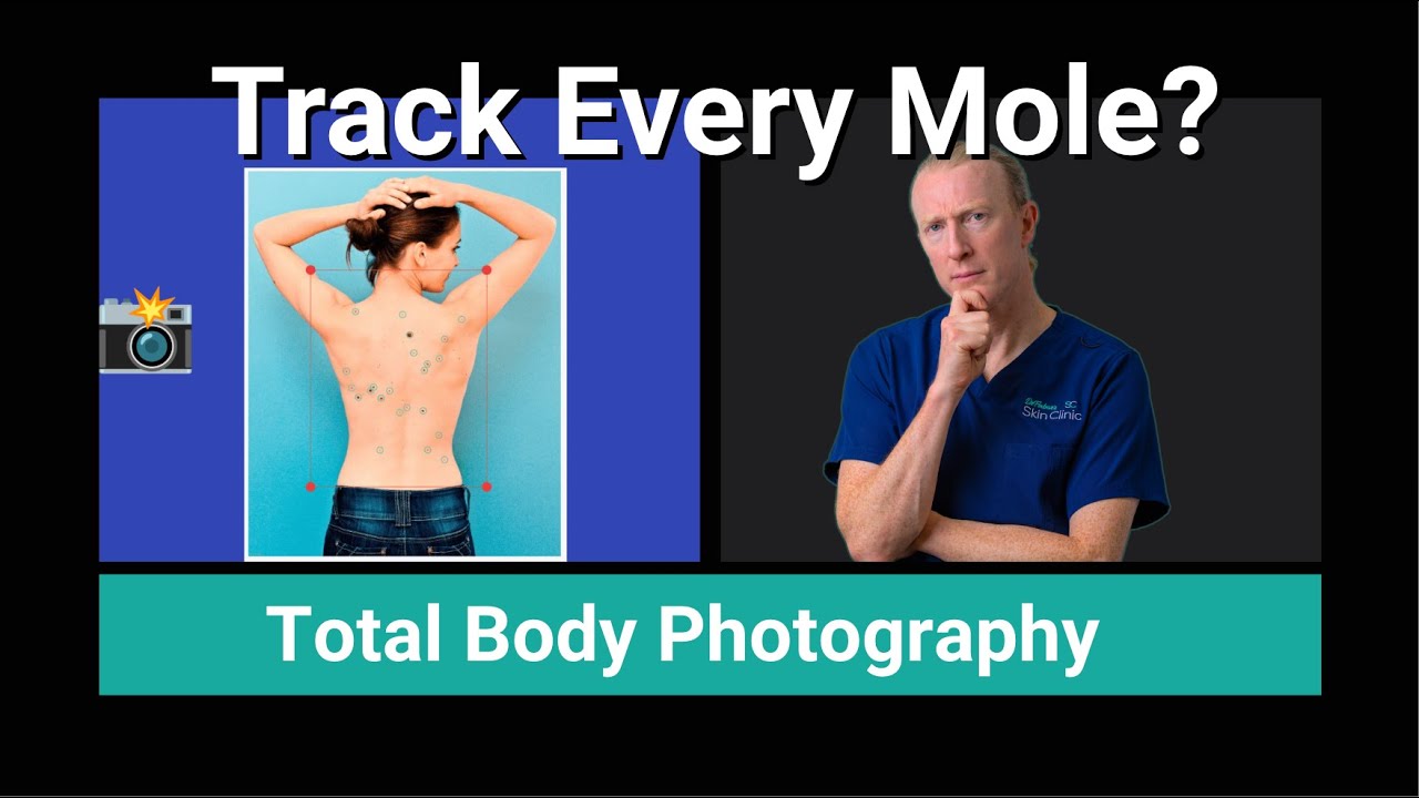 Full-Body Mole Map: How Total-Body Photography Spots Skin Cancer Early