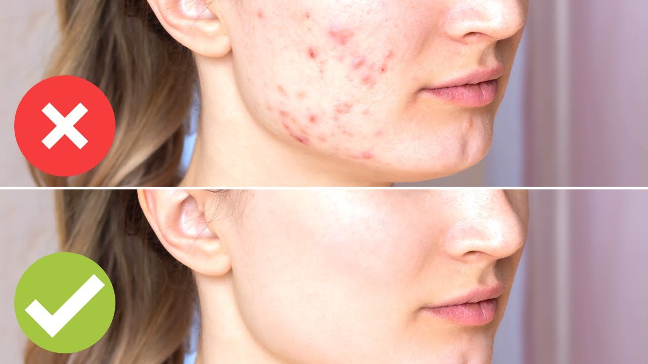 10 skutecznych domowych środków na trądzik