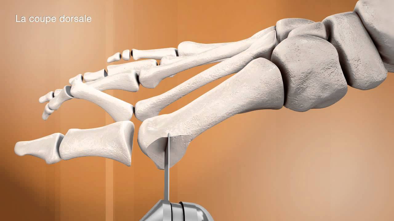 6 L'ostéotomie en chevron - Dr. Coillard | Dr. Boublil | Dr. Grisard -