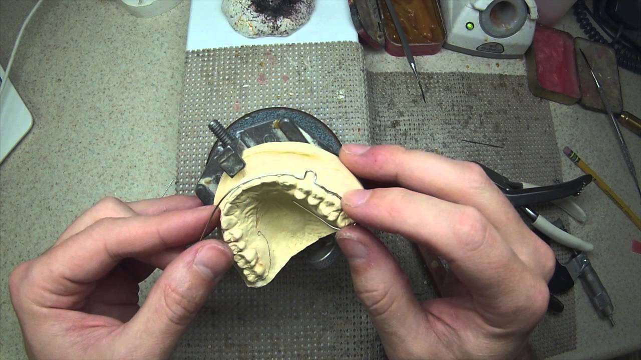 Wraparound Retainer (Edited -Version)