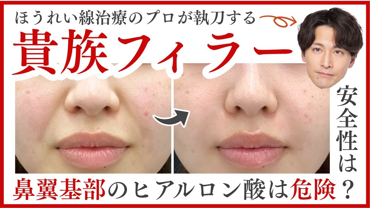 【ほうれい線治療】貴族フィラーのプロが鼻翼基部ヒアルロン酸の危険性について話します｜血流障害を防ぐ貴族フィラーのやり方