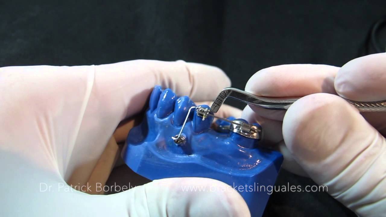 BIOMECÁNICA CON MINI IMPLANTES # 6 MESIALIZACIÓN MOLAR 2