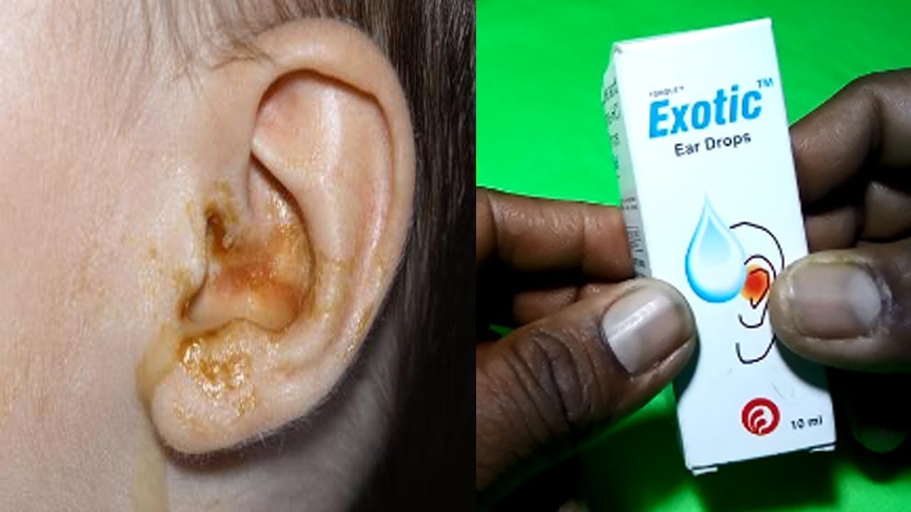 Exotic Ear Drop Review, Uses And Side Effects