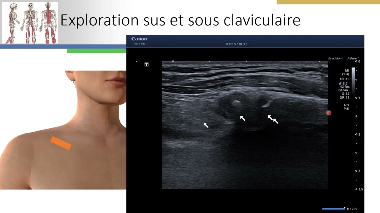 Syndrome du défilé cervico thoracique: analyse par l'échographie