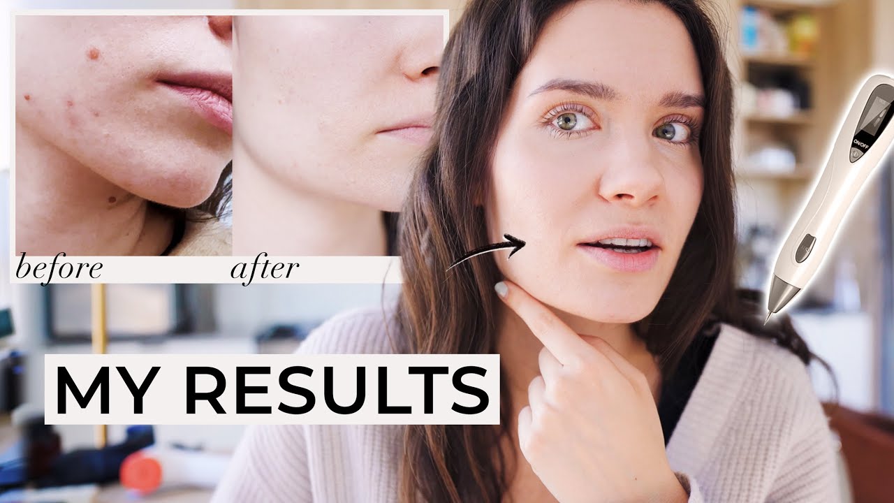 Как избавиться от папиллом, родинок и бородавок | PLASMA IQ против PLASMA MOLE REMOTION РУЧКИ ДЛЯ...