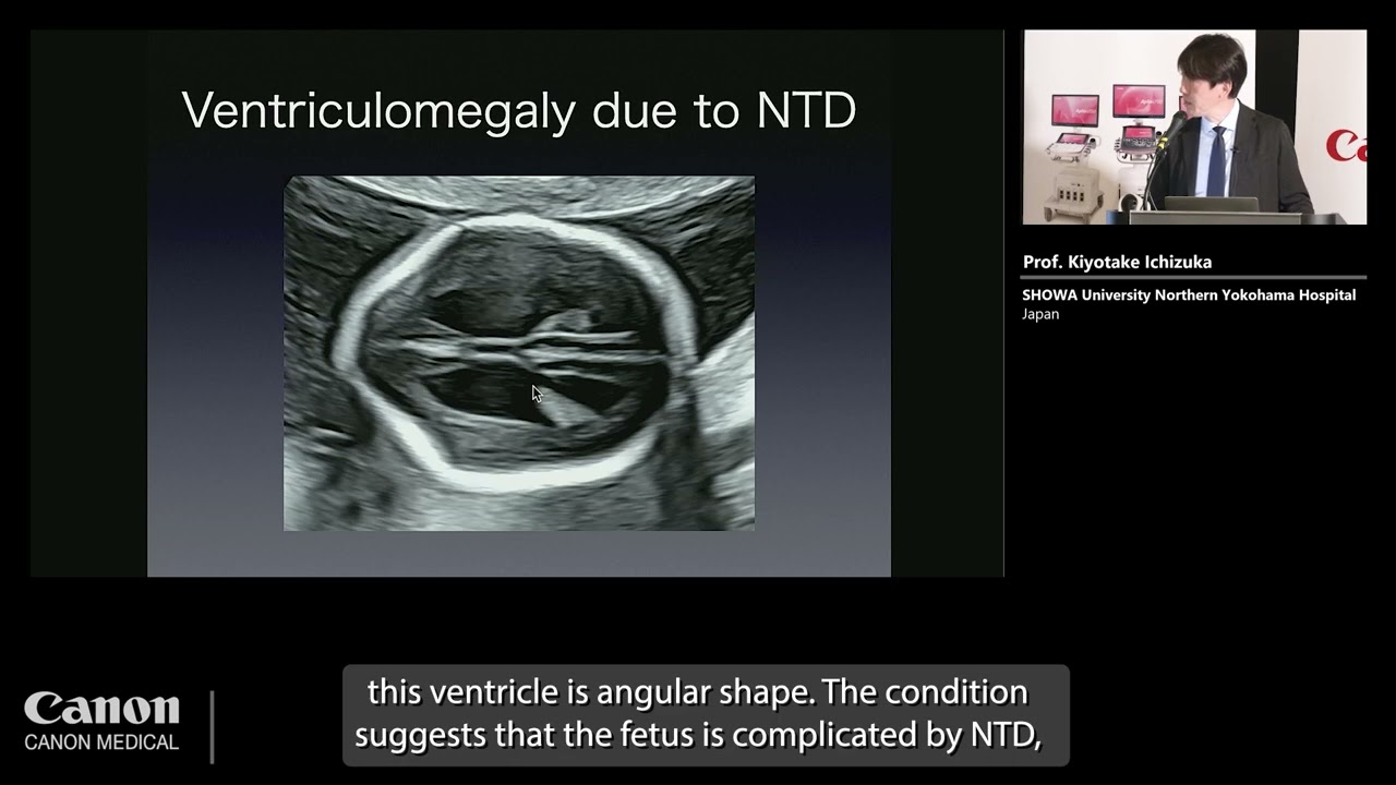 ISUOG 2023 &ndash; Prof. Kiyotake Ichizuka - 2nd trimester anomaly scan using the new Technology