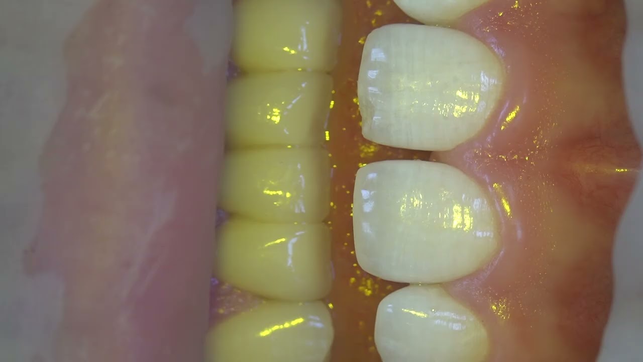 Front tooth composite restoration part1