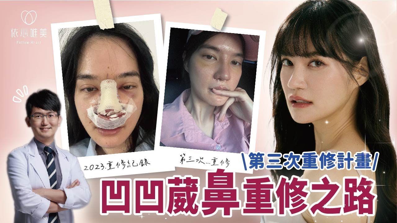 鼓起勇氣再次冒險！為何要鼻重修？原來細節這麼多！Ft.凹凹葳  @ououyu ｜依心唯美 謝東穎醫師