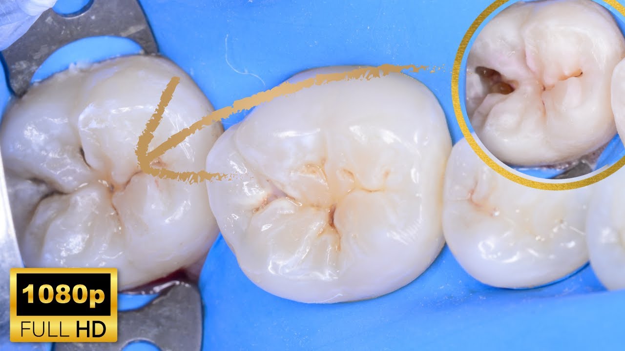 AWESOME REAL Minimally Invasive No Drilling Cavity Removal + Filling & Sealant in HIGH DEF