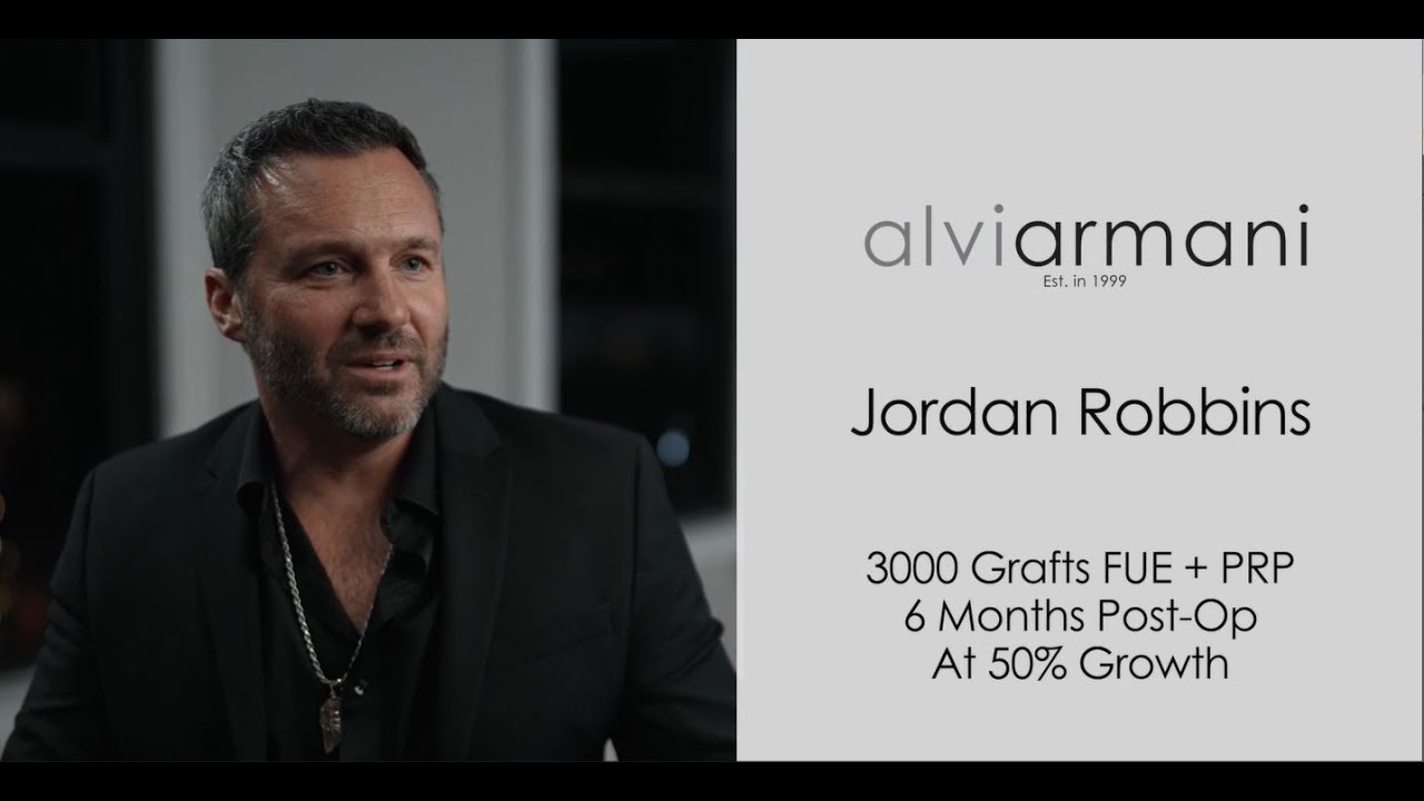 3,000 Graft FUE Hair Restoration - AlviArmani