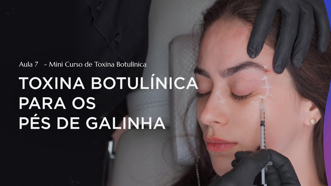 Aula 7 - Como melhorar os Pés de Galinha com Toxina Botulínica