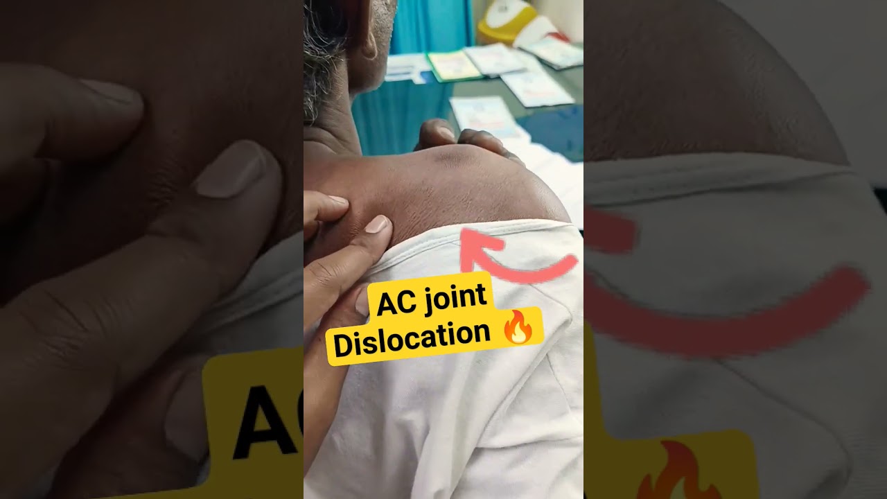 AC Joint Dislocation ☑️#shoulderdislocation #shoulderworkout #shoulderpain#shoulder #कंधा #shoulders