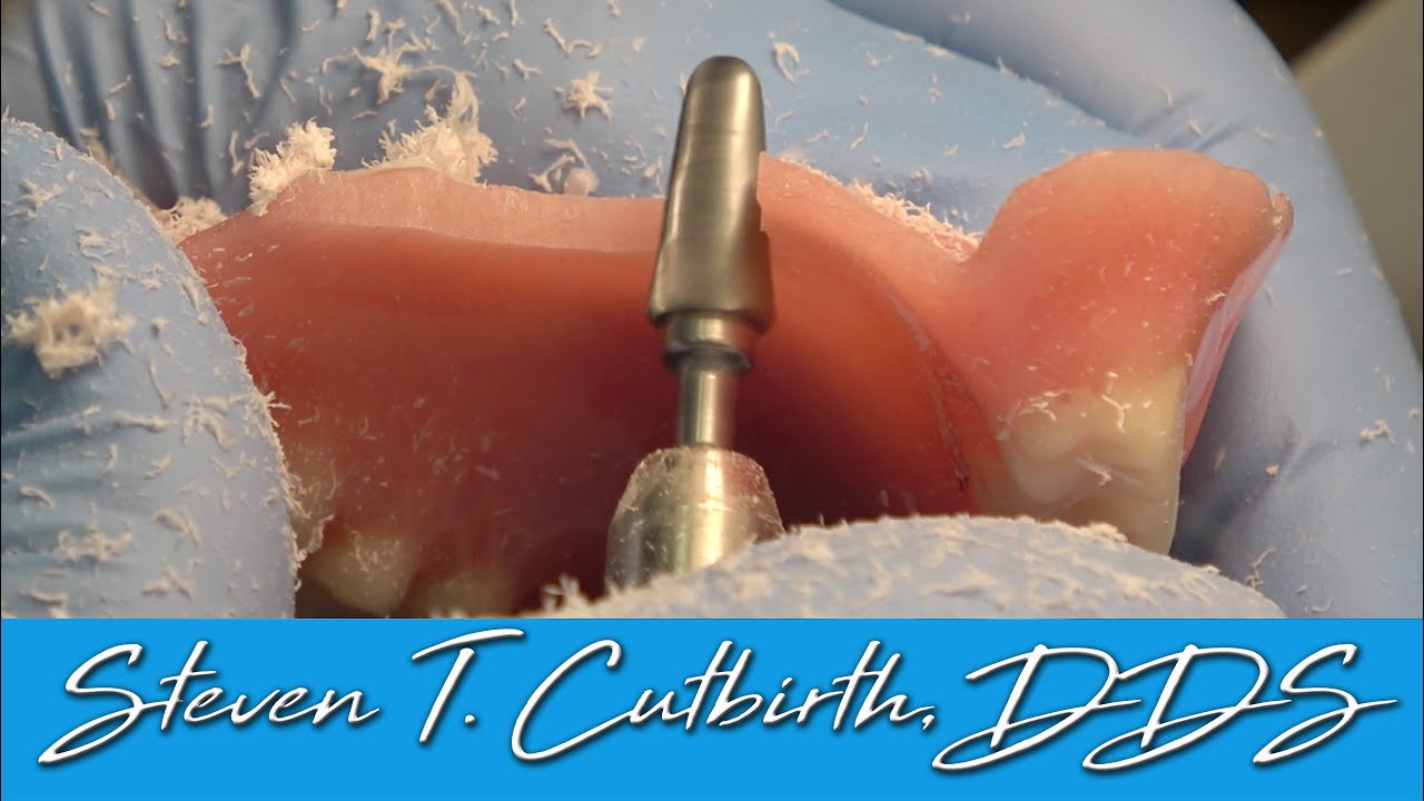 Removing Palate from Implant Secured Denture - Dental Minute with Steven T. Cutbirth, DDS