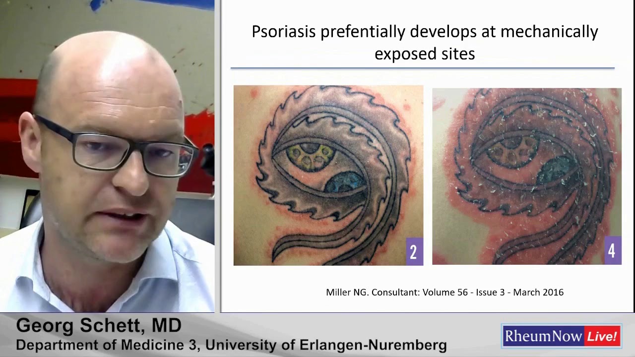RheumNow Live Preview with Dr. Georg Schett