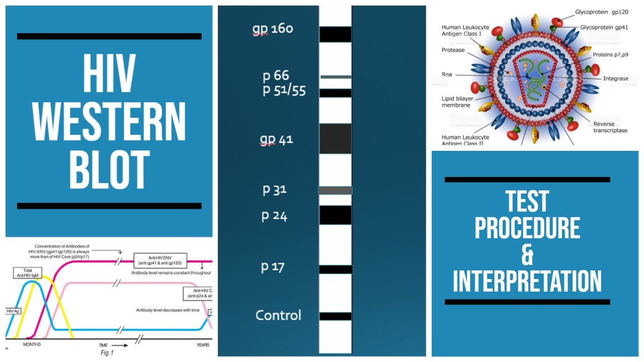 HIV western blot | SDS gel | procedure | Interpretation | #pathology #pathologylab #biochemistry
