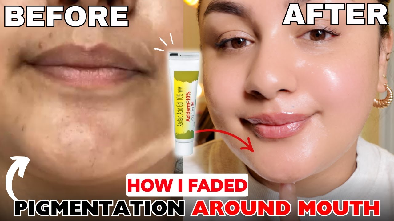 With just One Product  I faded Pigmentation Around Mouth (*Proof before /after )