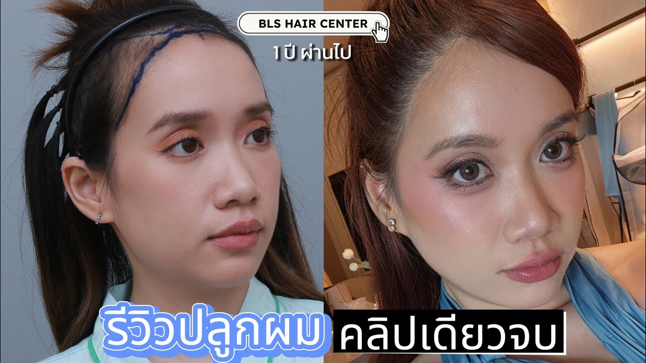 รีวิวปลูกผมกรอบหน้าผู้หญิง ตั้งแต่ต้นจนจบ1 ปีที่ BLS Haircenter ลืมไปเลยว่าเคยเถิก - Unfull Ice