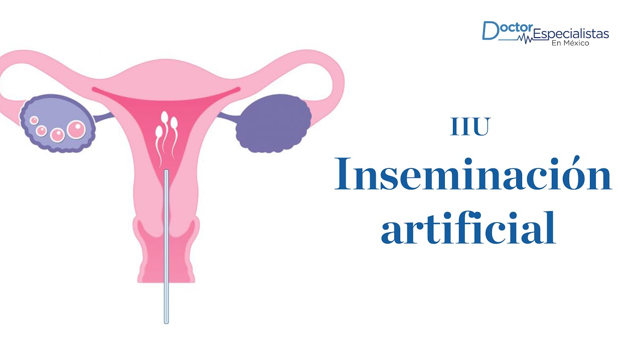 Inseminacion artificial (IIU) - Doctores Especialistas