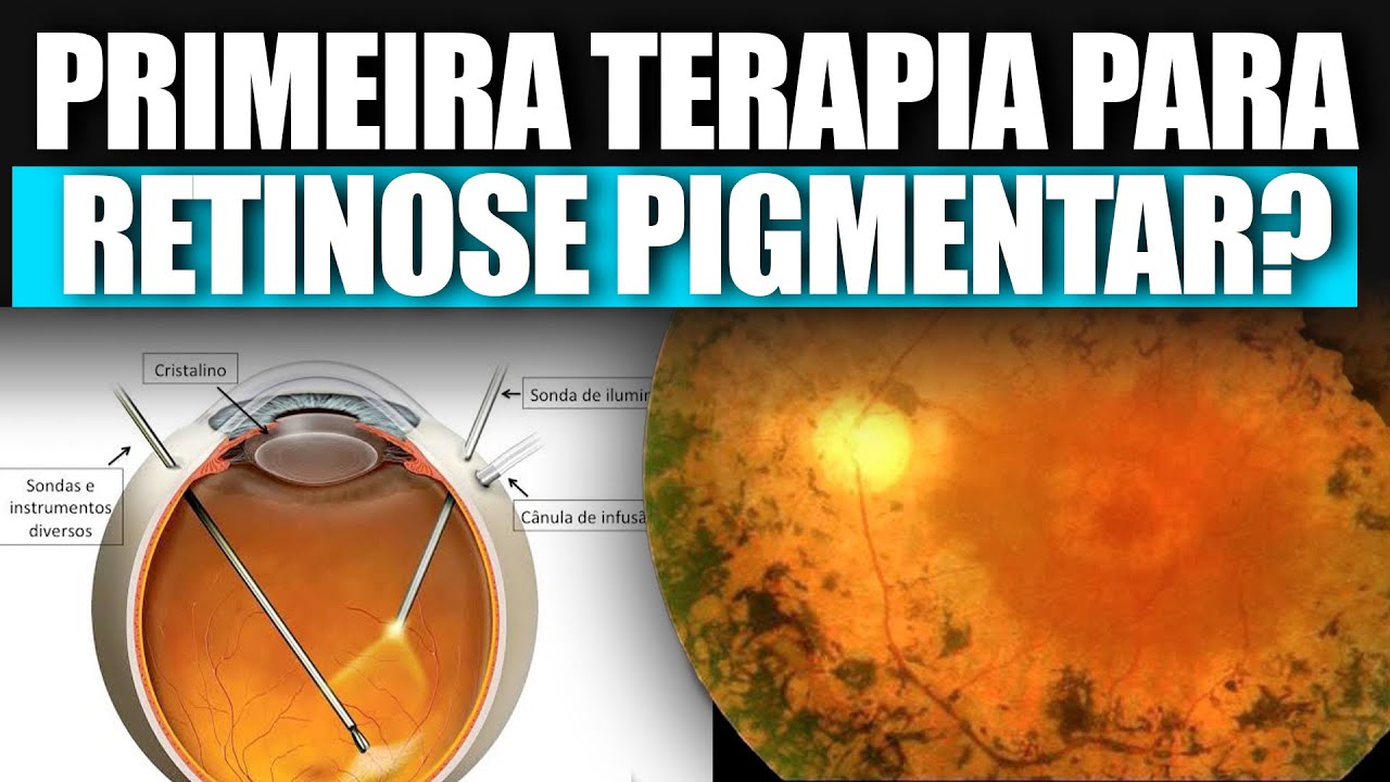 Primeiro Tratamento para Retinose Pigmentar?
