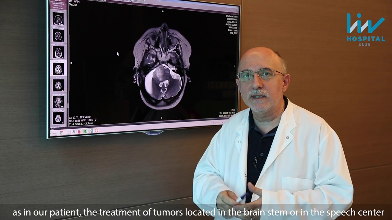 Brain tumor treatment in Liv Hospital, Turkey