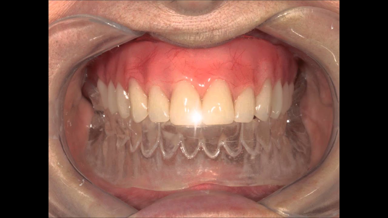 Pr&oacute;tese sobre implantes com carga imediata tipo protocolo branemark - www.blosodontologia.com.br