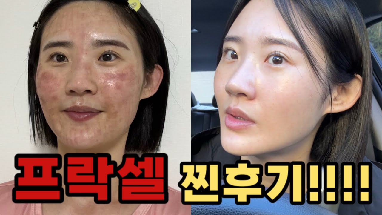 [EP.13] 모공, 여드름 흉터, 좁쌀 여드름 깐달걀로 만들자 ㅣ프락셀 찐후기ㅣ프락셀후기ㅣ광고❌