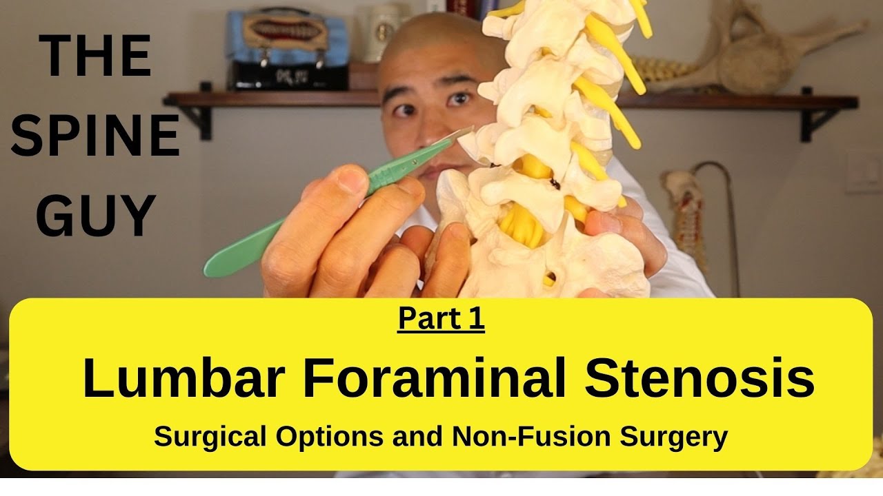 Lumbar Foraminal Stenosis - Decompression Surgery to Avoid Fusion