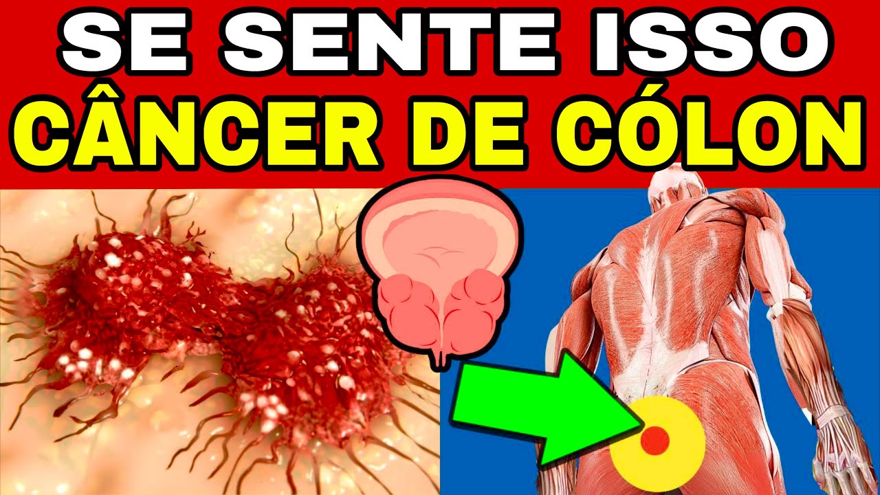 7 SINAIS de CÂNCER de INTESTINO que ESTÃO TE MATANDO SILENCIOSAMENTE + 3 ERROS FATAIS!