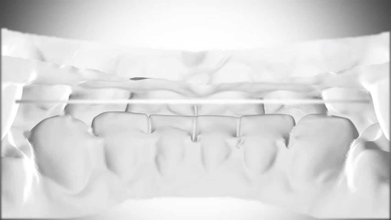 Something you've never seen before! The digital lingual retainer MEMOTAIN®