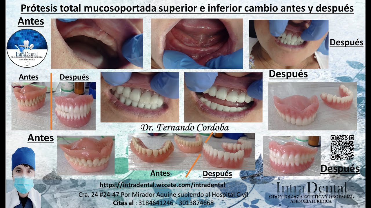 prótesis total mucosoportada superior e inferior