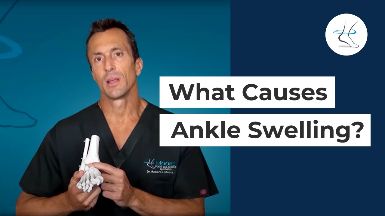 What Causes Ankle Swelling? | Ask Dr. Moore, Houston Foot and Ankle Surgeon